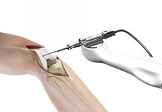 Computer-assisted Knee Replacement